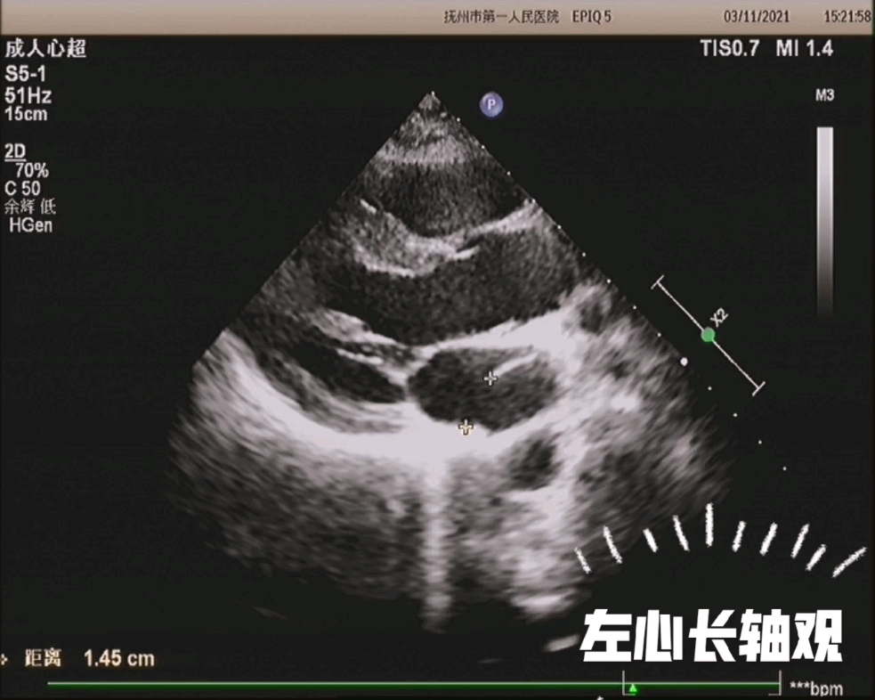 【心超】少见病例分享—左侧三房心哔哩哔哩bilibili