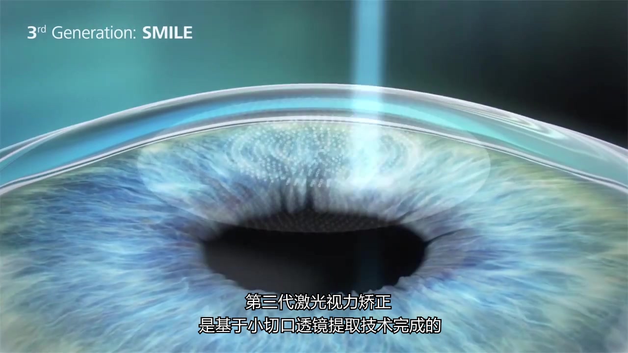 近视激光手术的原理(PRK,LASIK,SMILE)哔哩哔哩bilibili