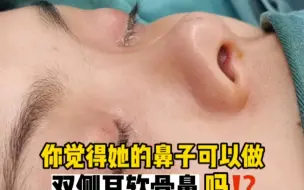 Descargar video: 朝天鼻、露鼻孔、塌鼻梁、短鼻，你觉得可以用双侧耳软骨后会变成什么样？