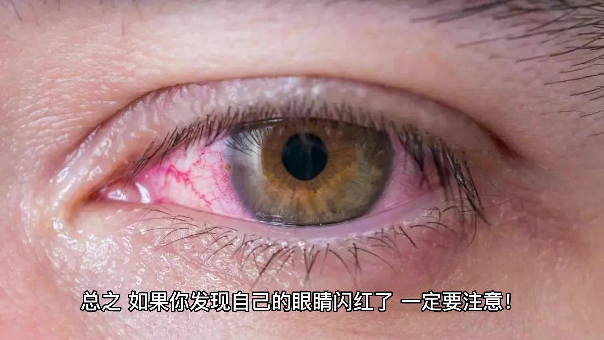 [图]眼睛红血丝咋办啊？