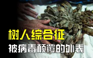 Download Video: 手术切除无效！患者目睹自己被体内“树木”禁锢