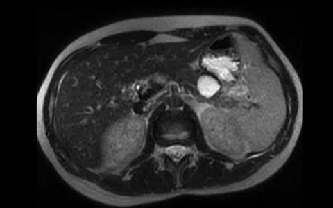 108 (胰腺粘液性囊性肿瘤)Mucinous cystic neoplasm of the pancreas哔哩哔哩bilibili