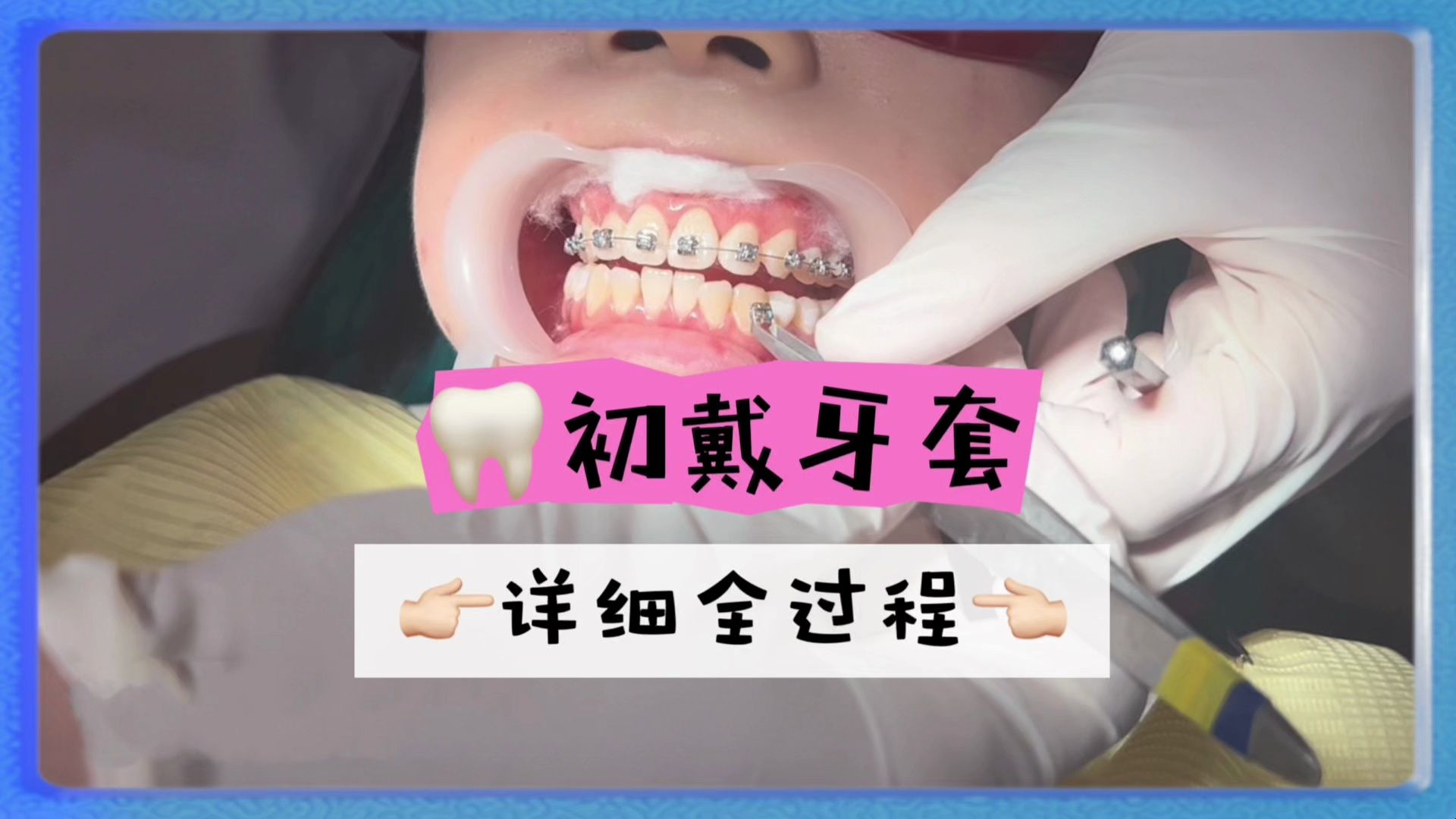 固定牙套初戴记录