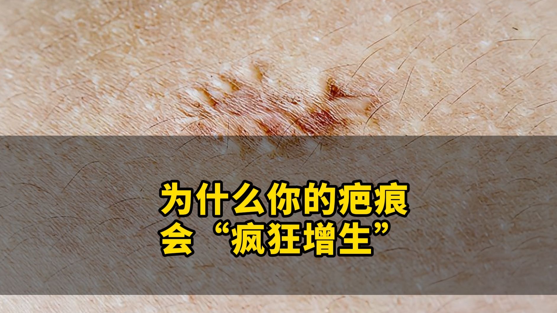 为什么会疤痕增生 为什么会疤痕增生