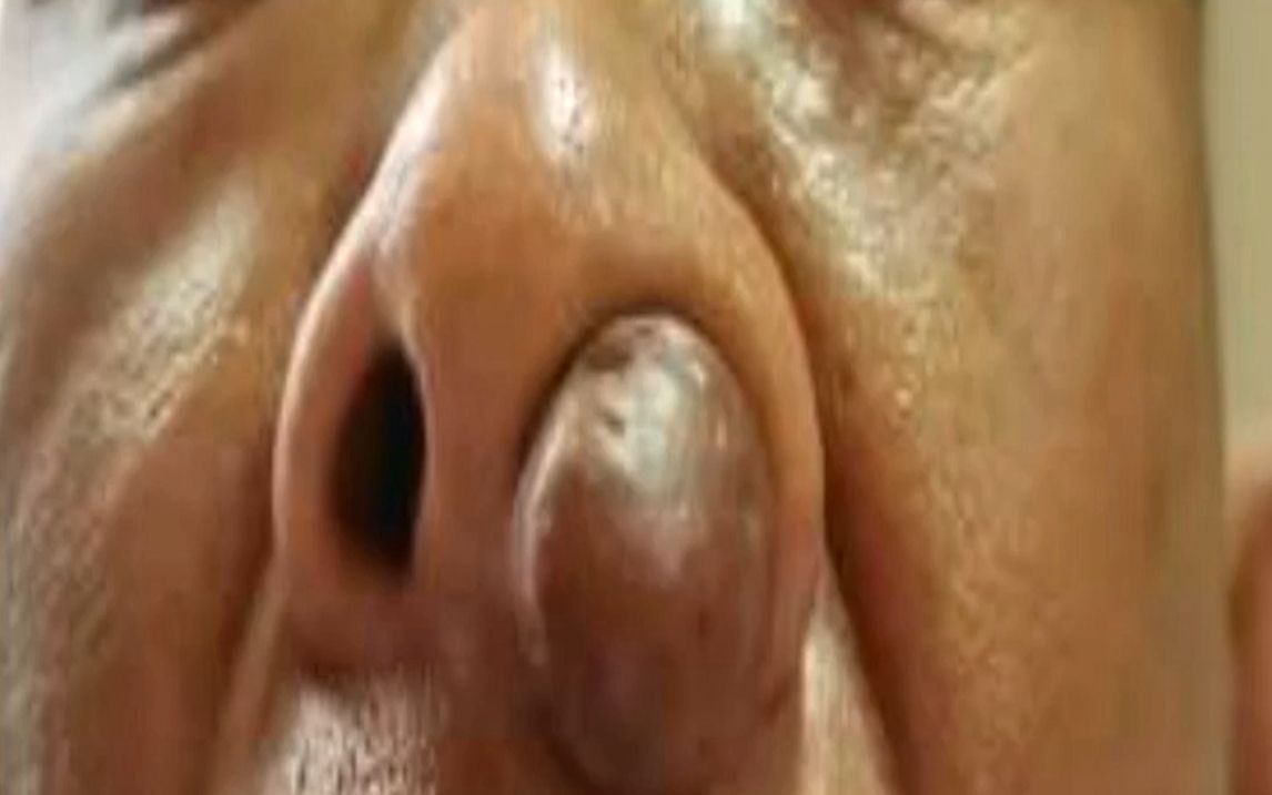 男子鼻孔被堵但不痛不痒,20多年没管,小颗粒长成"鹌鹑蛋"!