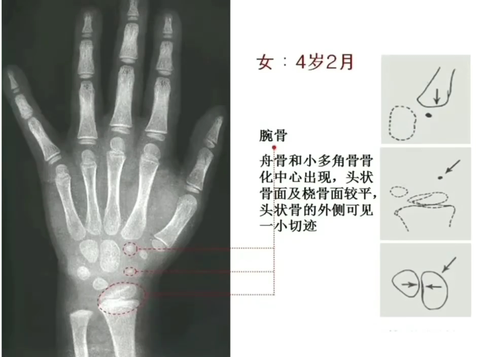 【018岁女孩标准骨龄片】很多家长不懂怎么看骨龄片 不同年龄,生长空间不一,如果孩子骨骺线完全闭合,还想长高基本没机会了,一定要及时关注!哔...