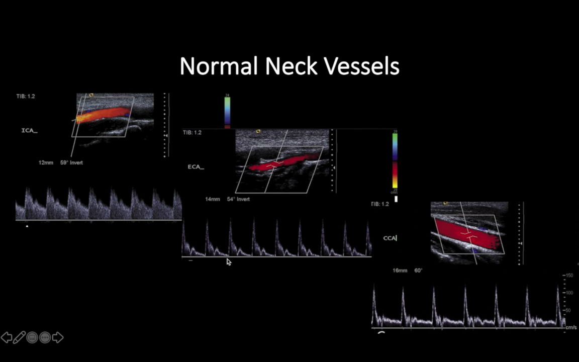 【Ultrasound Doppler Part 2】超声多普勒频谱分析哔哩哔哩bilibili