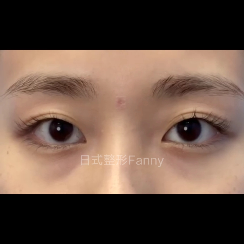 告别不明显的假双浅双眼皮日式无痕埋线双眼皮塑形自然日系的双眼皮