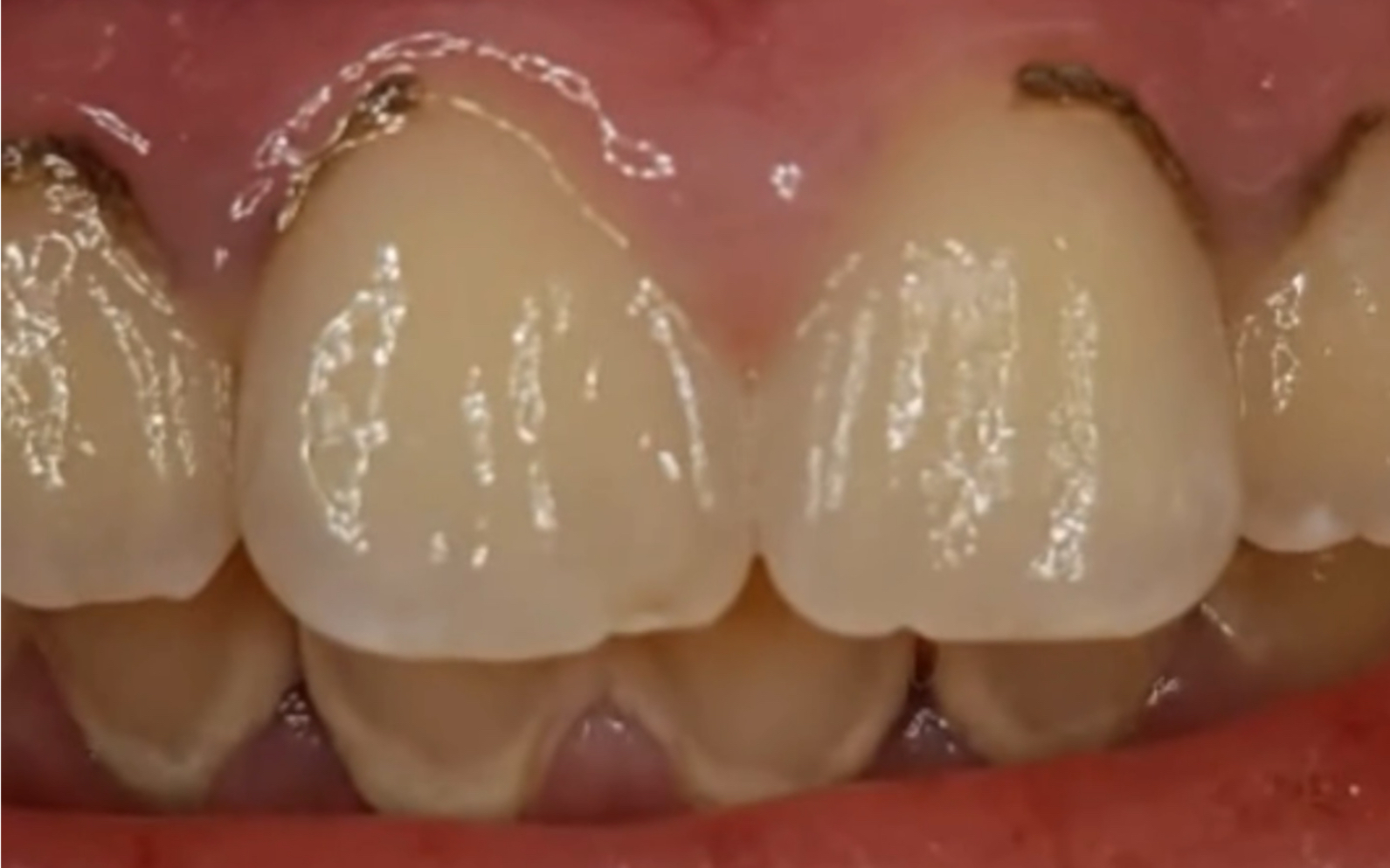 「深圳洗牙」前面牙齿全是黄色和黄色的牙结石!不讲武德!