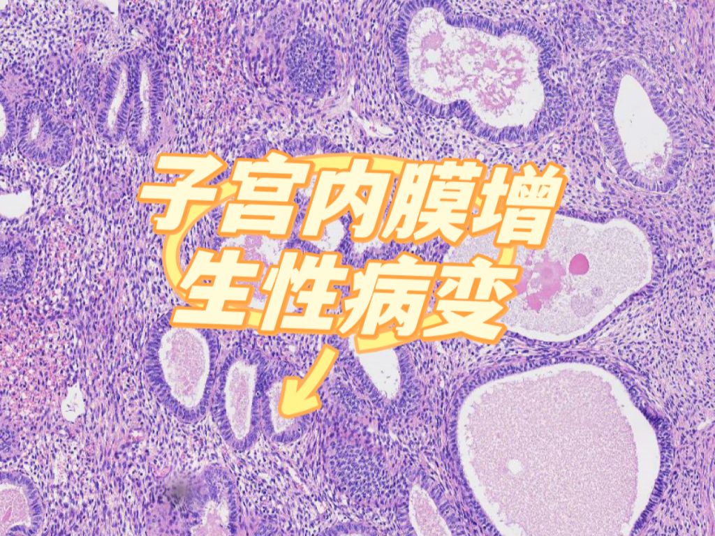 【病理学】子宫内膜不伴细胞非典型增生/非典型性子宫内膜增生哔哩哔哩bilibili