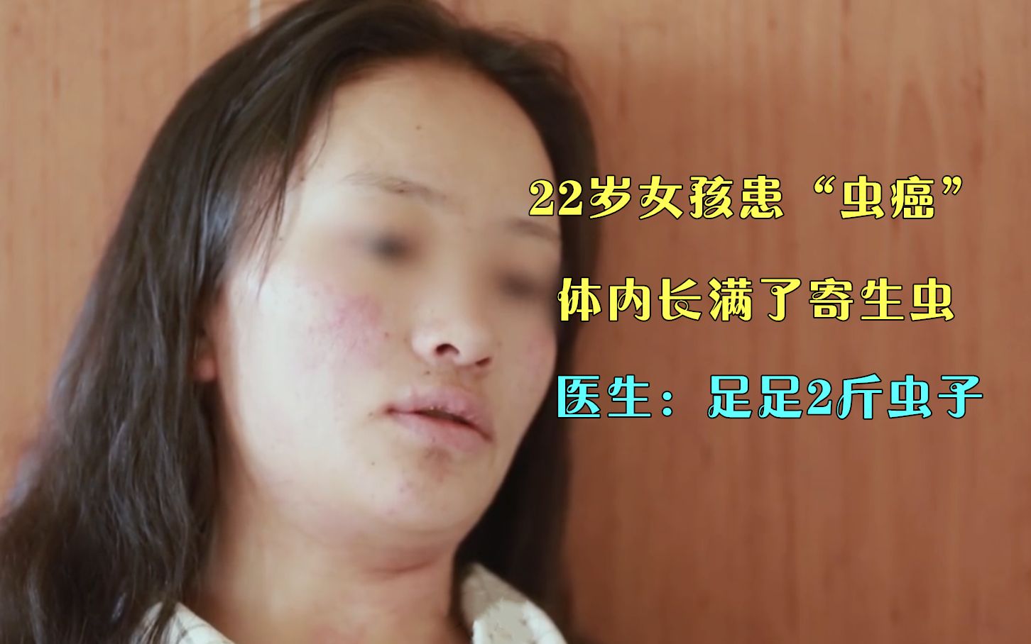 22岁女孩患“虫癌”,体内长满寄生虫,医生:肝脏上足足2斤虫子哔哩哔哩bilibili