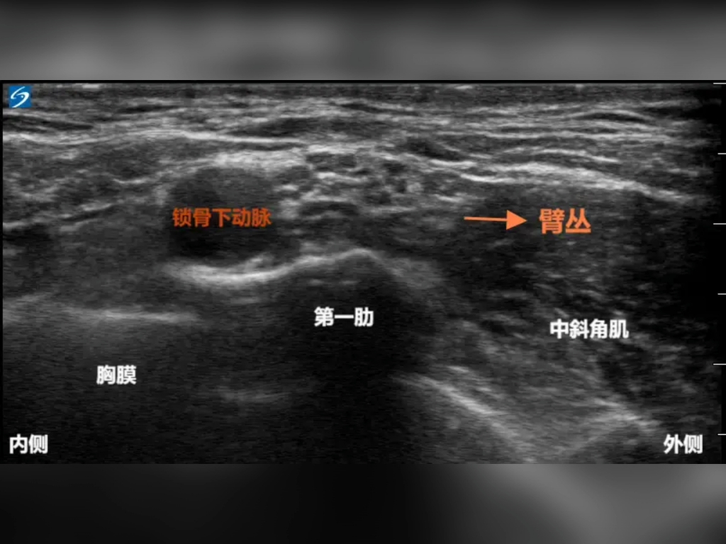 臂丛神经阻滞 定位图片