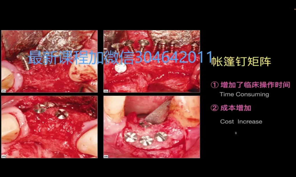 钛网在骨增量的应用——李军老师骨增量(共13节)哔哩哔哩bilibili