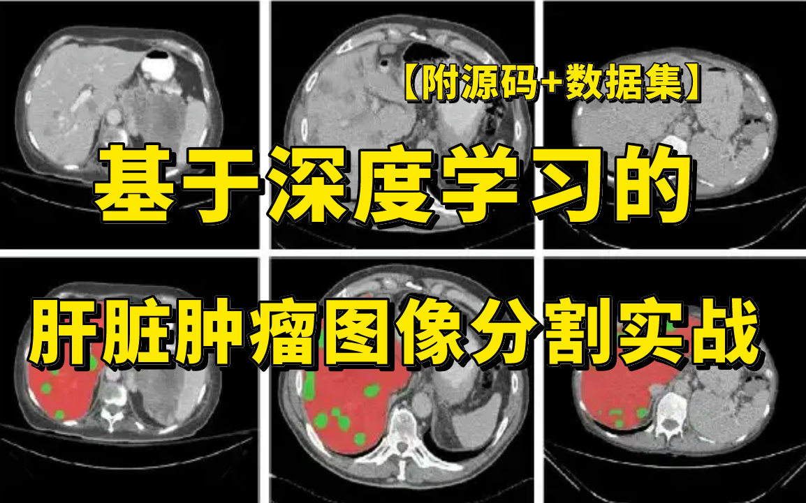 【附源码+数据集】基于深度学习的医学图像处理实战:肝脏肿瘤图像分割,从环境部署到项目实战,究极通俗易懂!(人工智能/机器学习/图像处理/计算机...