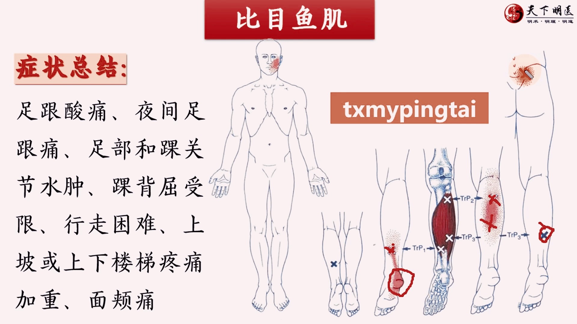 比目鱼肌的位置,比目鱼肌的功能,比目鱼肌的激痛点,比目鱼肌损伤后的