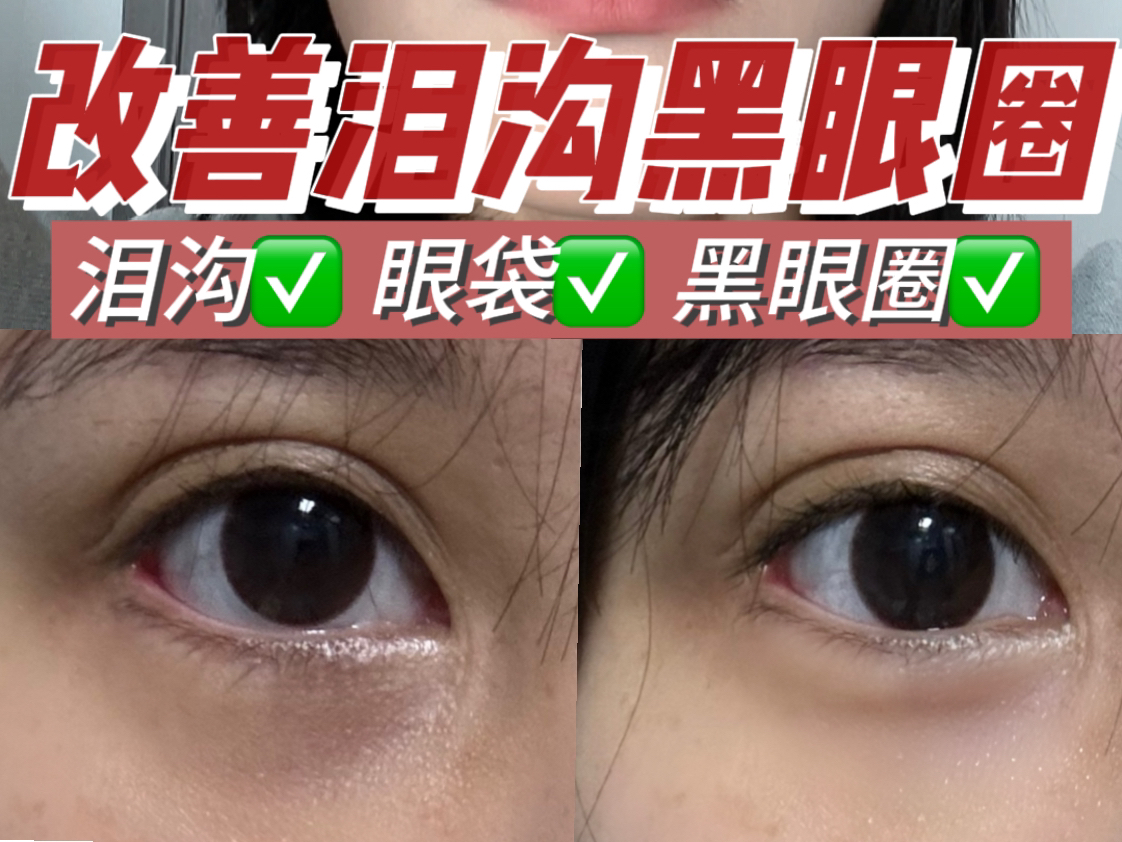 开始我也不信…泪沟真没了6315一次见效05