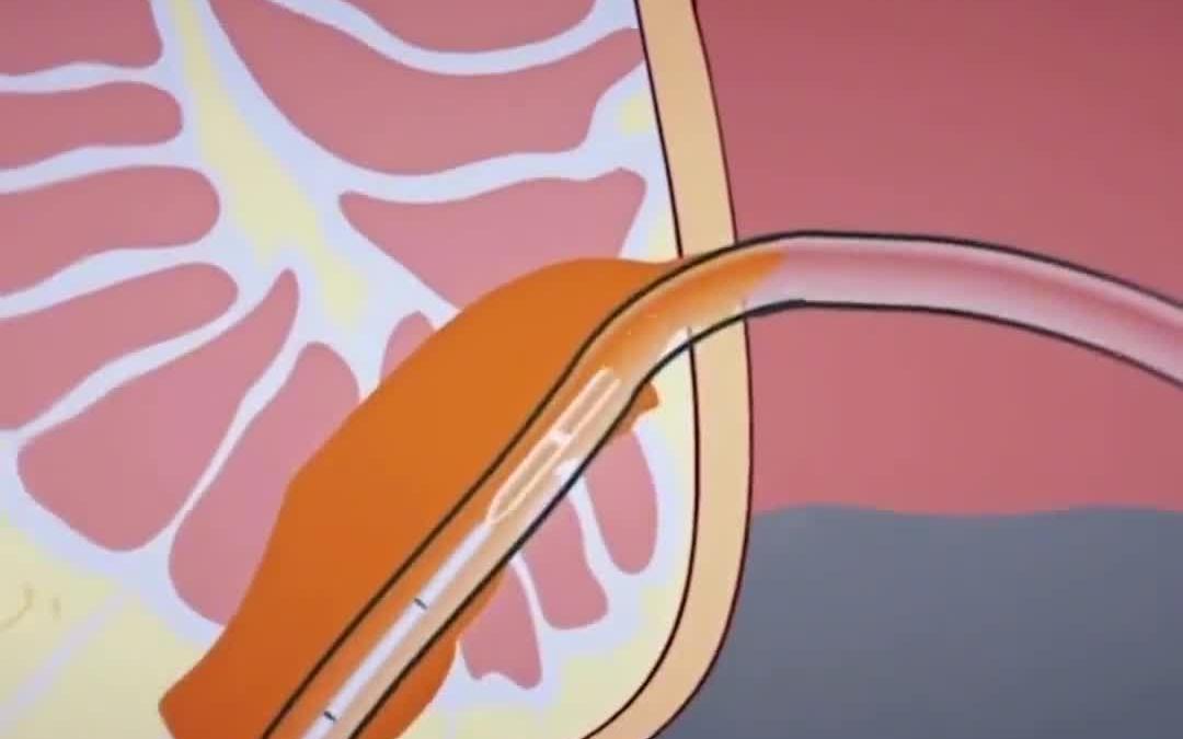 肛周脓肿手术动画演示图片