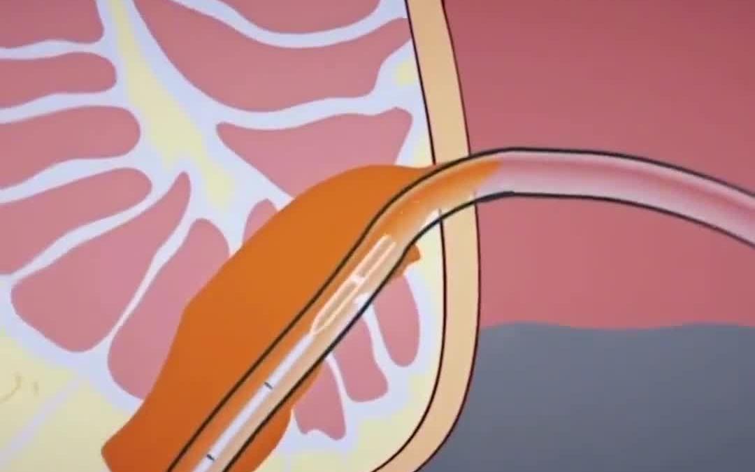 3d动画演示肛瘘手术 肛肠科张双喜医生 肛肠