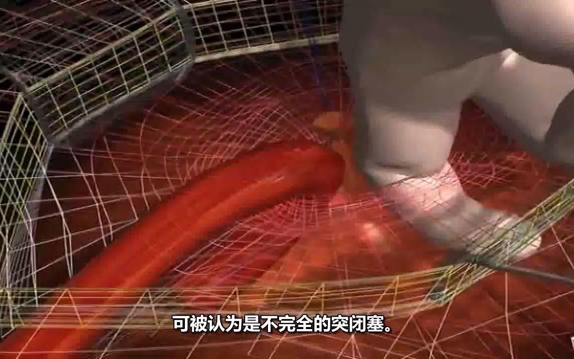 [图]腹腔沟斜疝和直疝科普动画3d演示