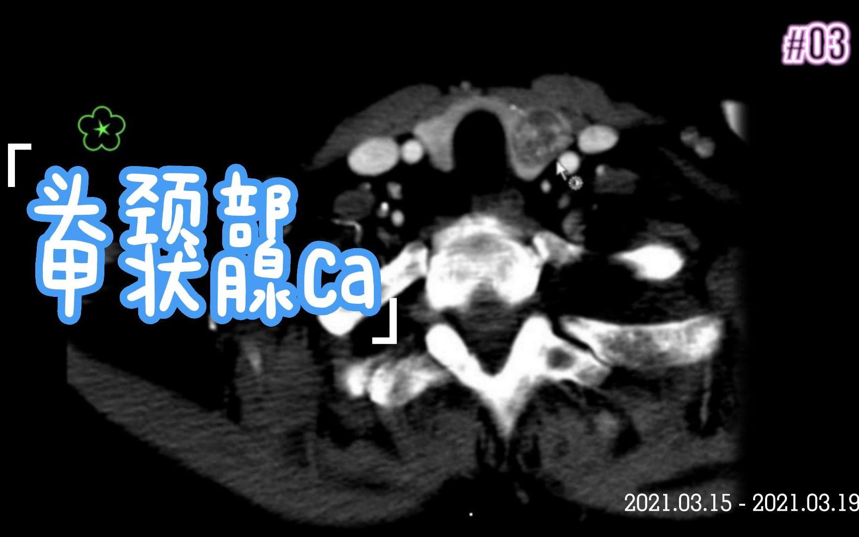 【头颈部】甲状腺ca哔哩哔哩bilibili