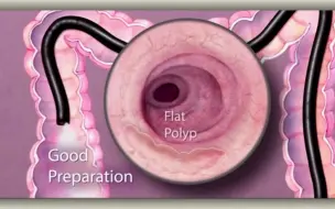 Скачать видео: 肠镜检查前，做好准备工作有多重要？