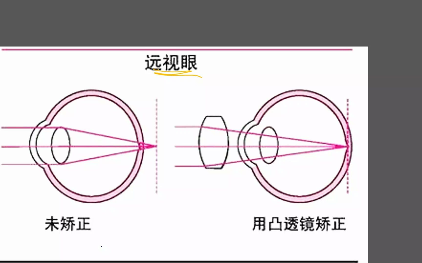 [图]猴Sir讲题220409: 这道题背后的原理你如果还沒理解，一定给我留言。何种折光异常时，视近物与远物都需调节？为什么？