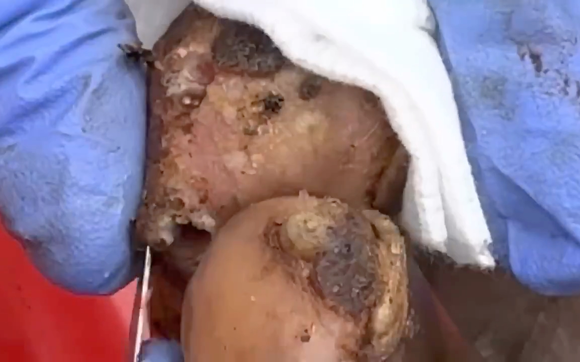 修脚,沙蚤脚清理