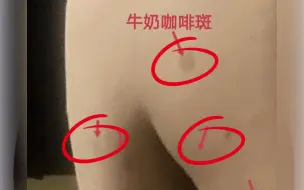 Download Video: 7岁女孩身上这些可不是胎记哦！是牛奶咖啡斑。