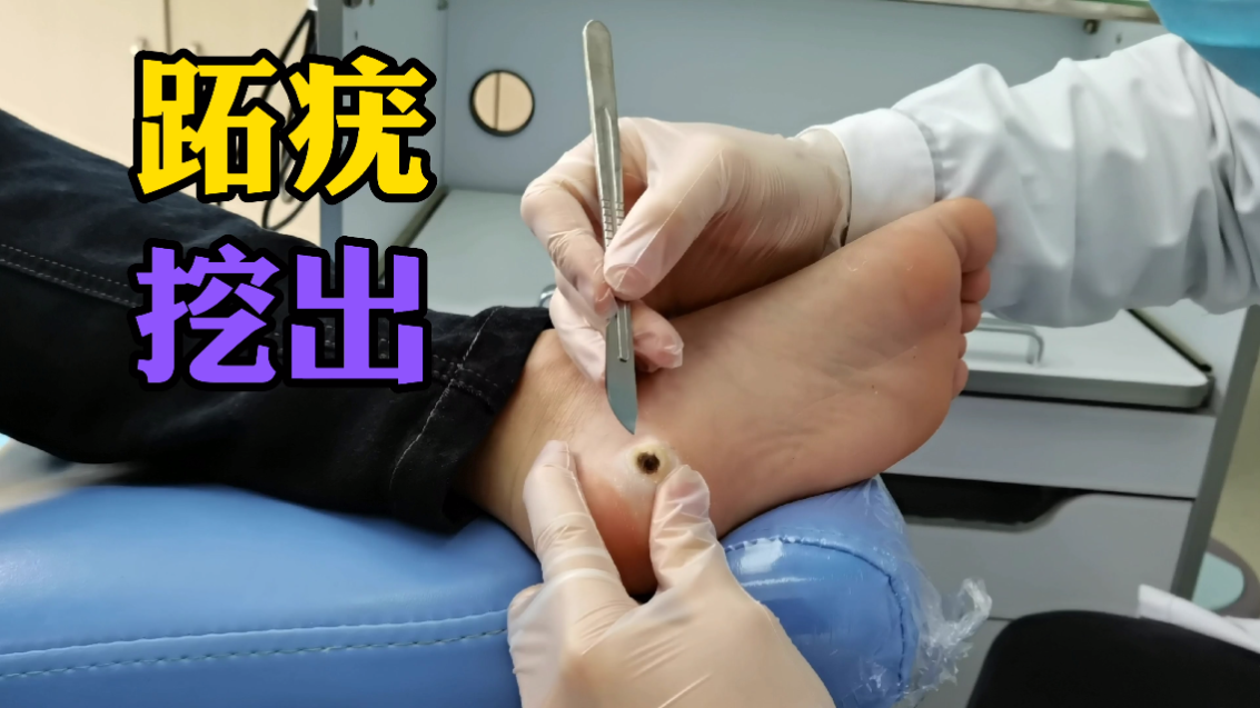 小哥哥脚上跖疣过来去除过程很轻松