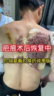 Descargar video: 疤痕术后恢复的很不错，想看术前的请看合集