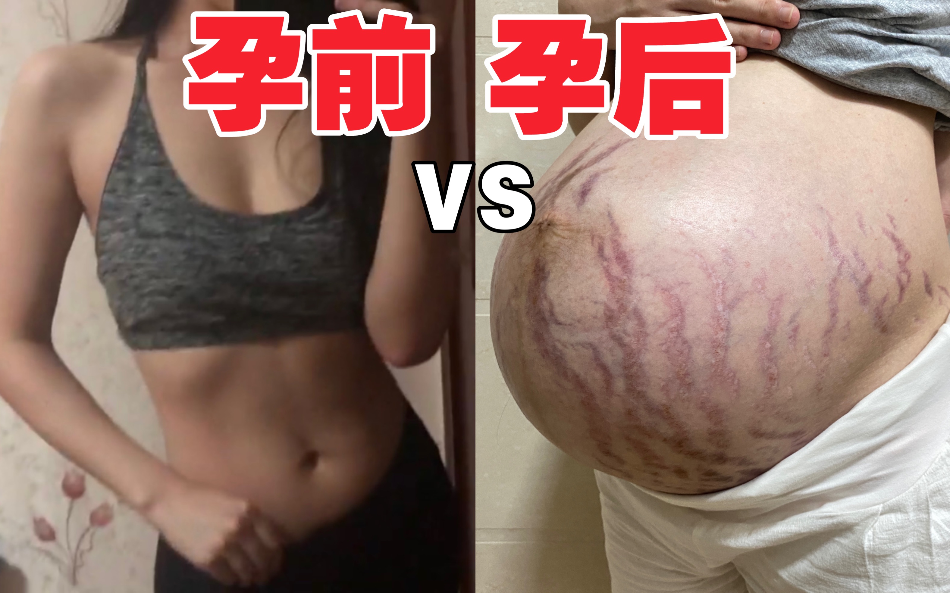 【孕期日记】孕晚期39周|这才是怀孕后的人间真实...重度妊娠纹特写镜头(画面易引起不适,害怕勿入)哔哩哔哩bilibili