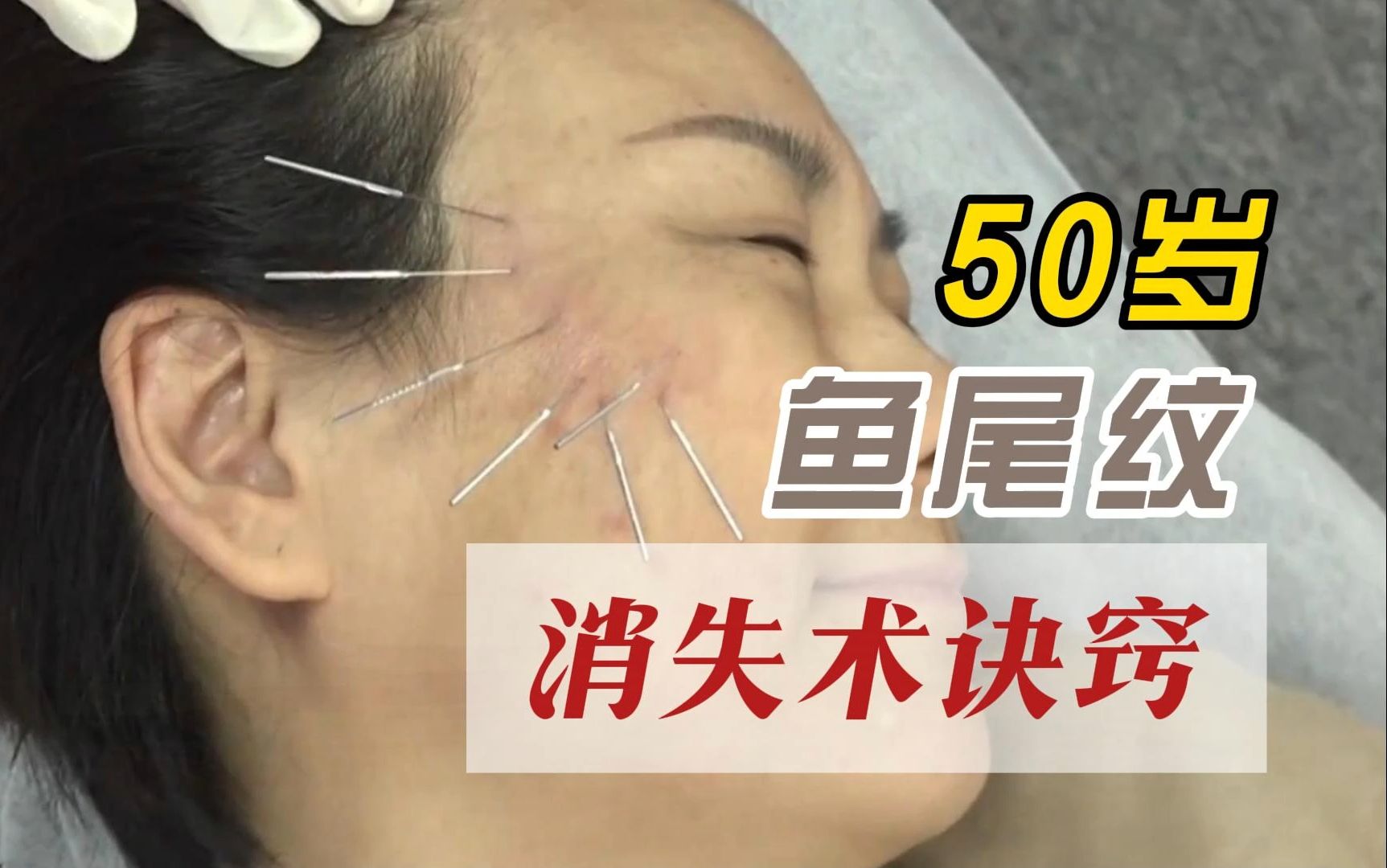 王瑞雪汉传针雕 50岁--让鱼尾纹消失诀窍 美雕 美容针灸 面部提升