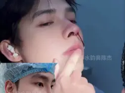 Tải video: 看呆了！男生超好看俊气直鼻⚡️|术后即刻