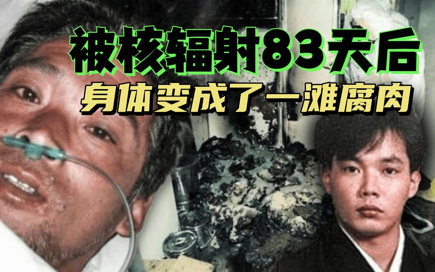 核辐射有多恐怖?一名健壮的日本男人变成一滩腐肉只需83天!哔哩哔哩bilibili