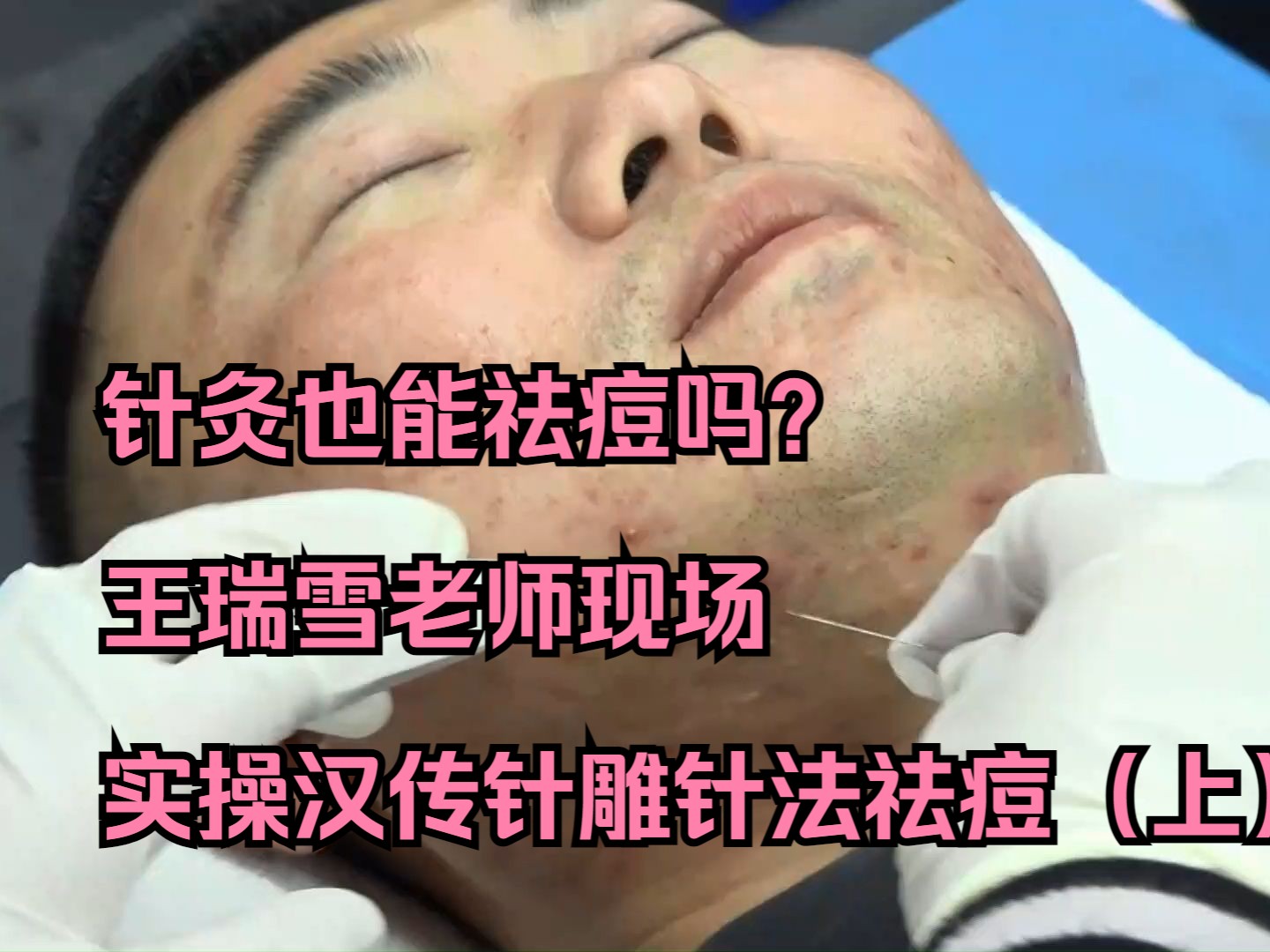 王瑞雪老师现场实操汉传针雕针法祛痘(上)
