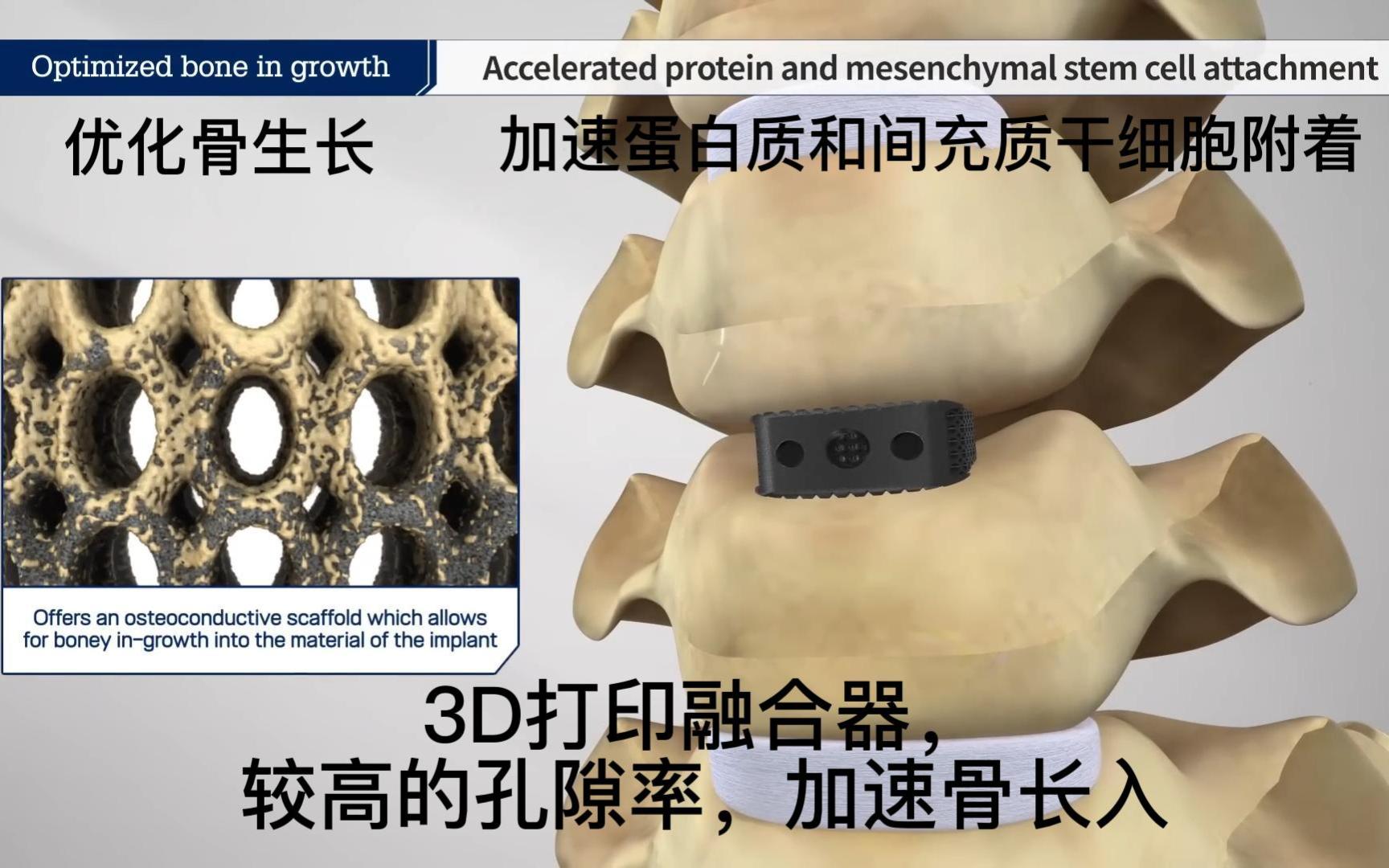 3D打印钛网融合器制造过程动画演示,植入人体的融合器是怎么制作的,一次看个够.哔哩哔哩bilibili