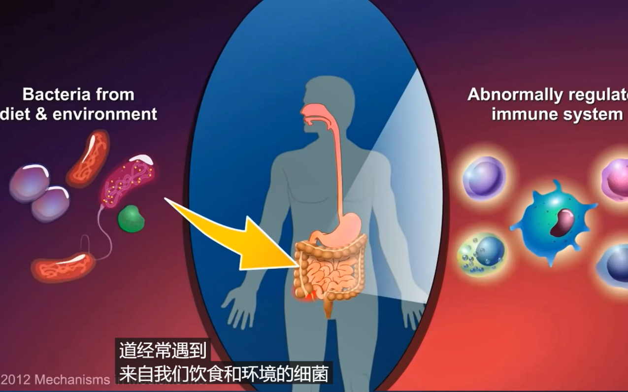 克罗恩病(Crohn's disease)AI机器学习风险预测模型,概述,流行病学统计,潜在风险因子,并发症,市场调研,潜在中药调理哔哩哔哩bilibili