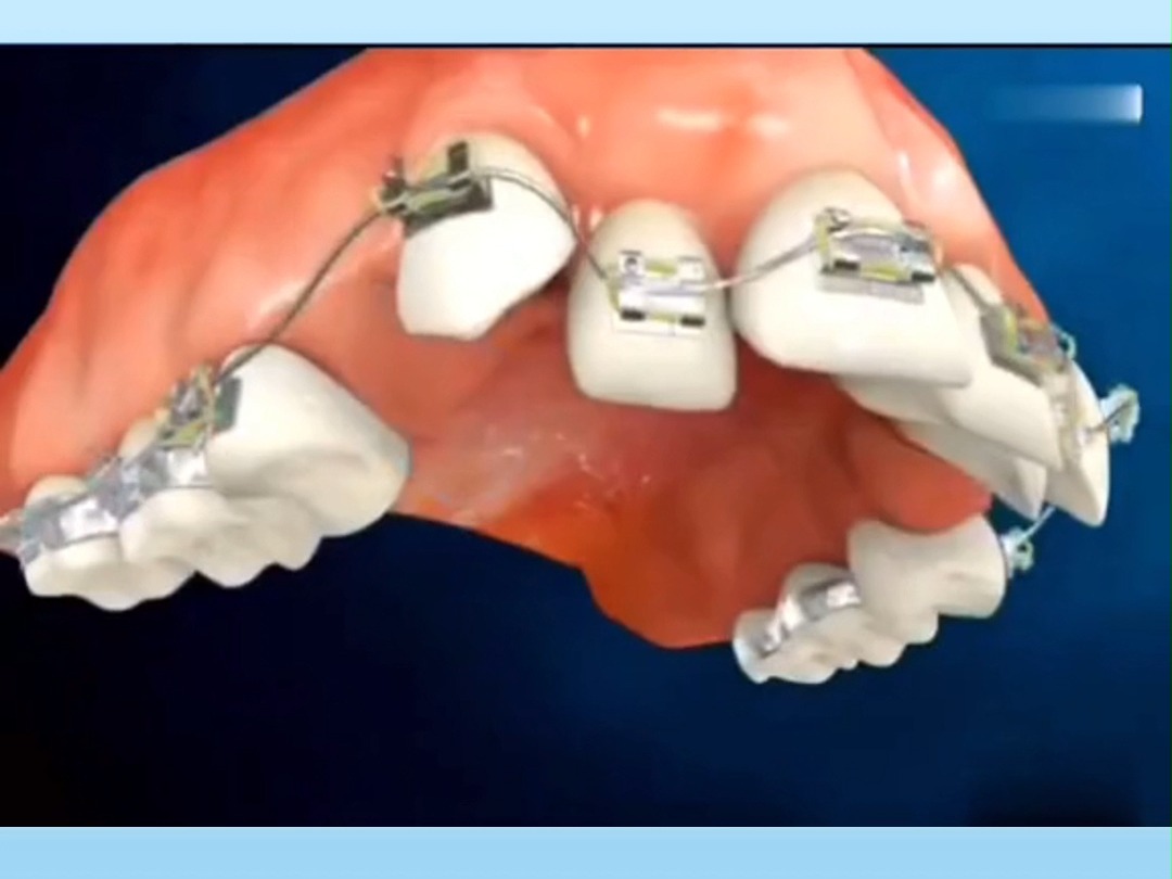 牙齿太拥挤,排列不齐,只能够掩面而笑?不妨看看矫正吧,让你的笑更灿烂 #牙齿拥挤#牙齿矫正#口腔科普 @烟台壹颗芽口腔哔哩哔哩bilibili