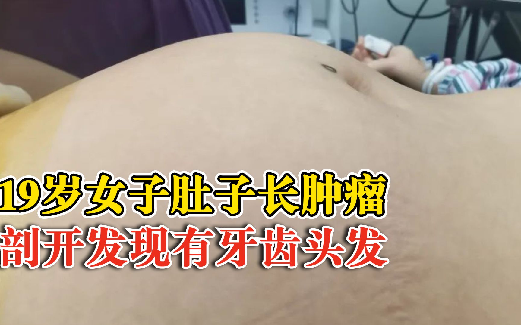 女子肚子里长肿瘤剖开后有头发牙齿,是生殖细胞肿瘤中常见的一种哔哩哔哩bilibili