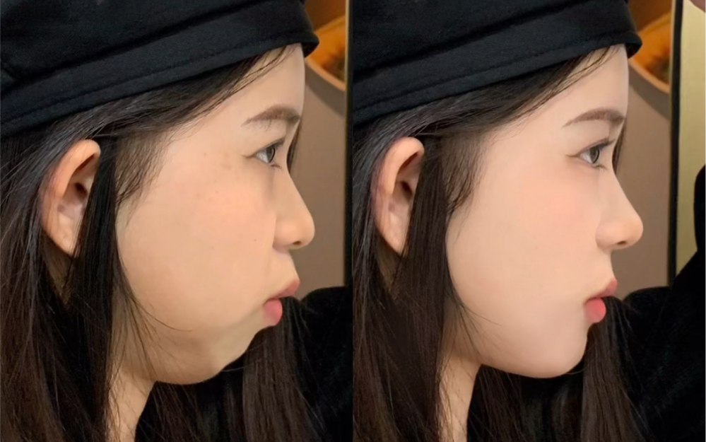 凸嘴下巴后缩的姐妹抱紧这个教程!_哔哩哔哩_bilibili