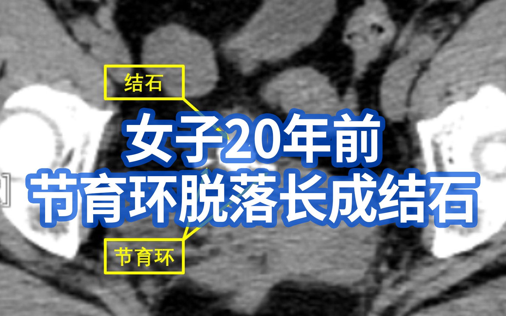 CT显示膀胱内长出“钻石戒指”,女子20年前节育环脱落长成结石哔哩哔哩bilibili