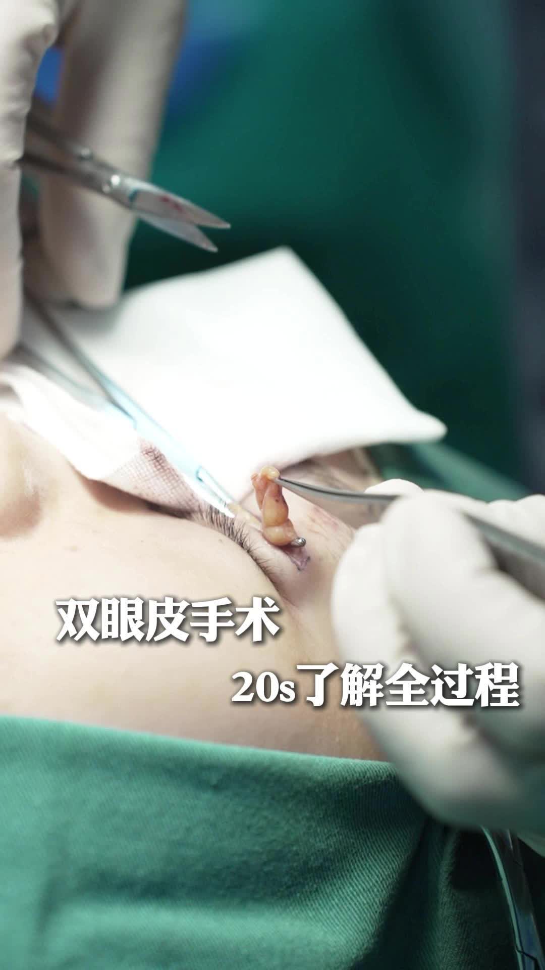 20s了解双眼皮手术全过程