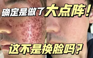 Tải video: ［严重痘坑］全网超细致剥脱点阵恢复全记录，内附小哥全程恢复照片。