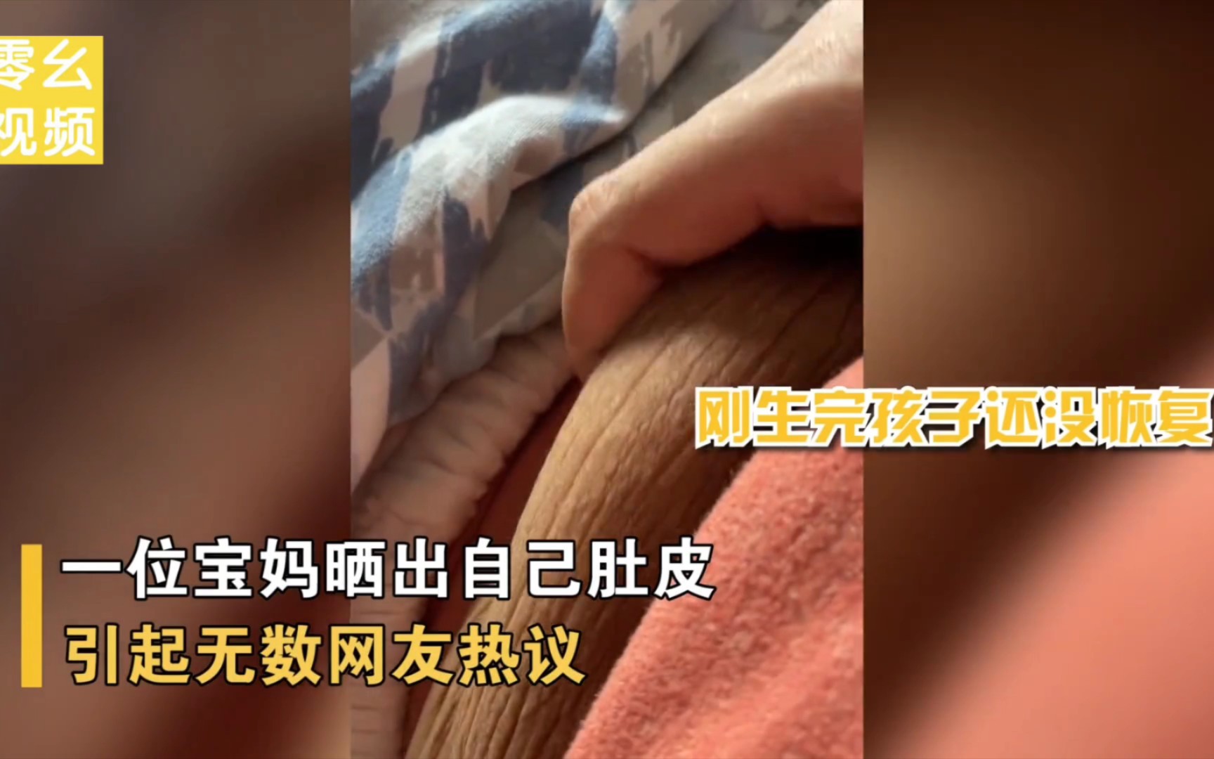 宝妈晒生完孩子的肚皮,皮肤黢黑还有妊娠纹,像是80岁的皮肤