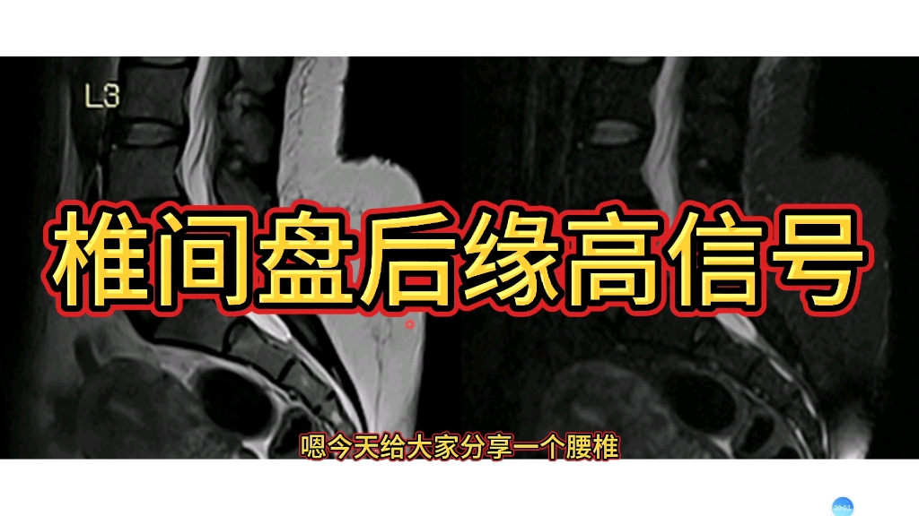 磁共振上椎间盘后缘的高信号代表什么?医生讲解!哔哩哔哩bilibili