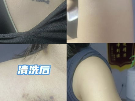 小姐姐洗图案纠结了两年,最终还是选择相信老魏#纹身#洗纹身#郑州#上