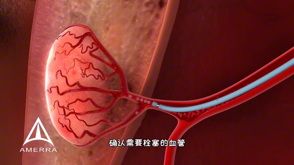 不手术治疗子宫肌瘤,介入栓塞动脉治疗子宫肌瘤,3D演示..哔哩哔哩bilibili