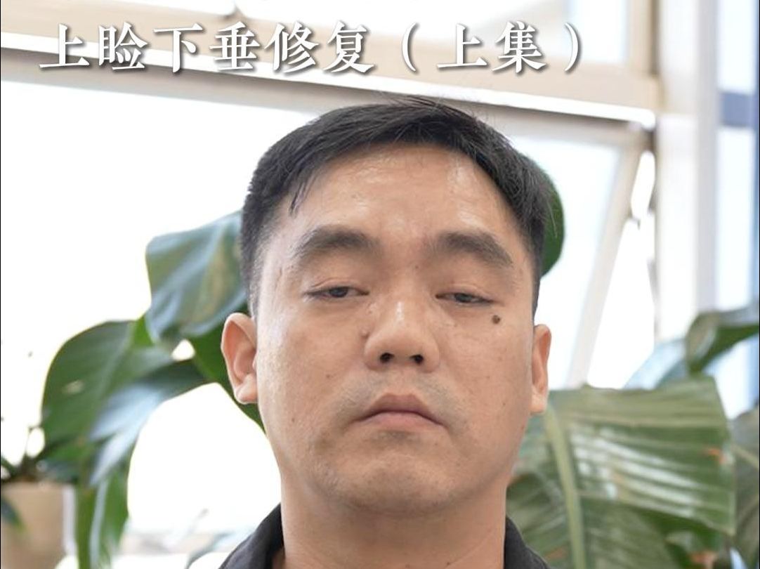 来自广东广州,双侧重度上睑下垂