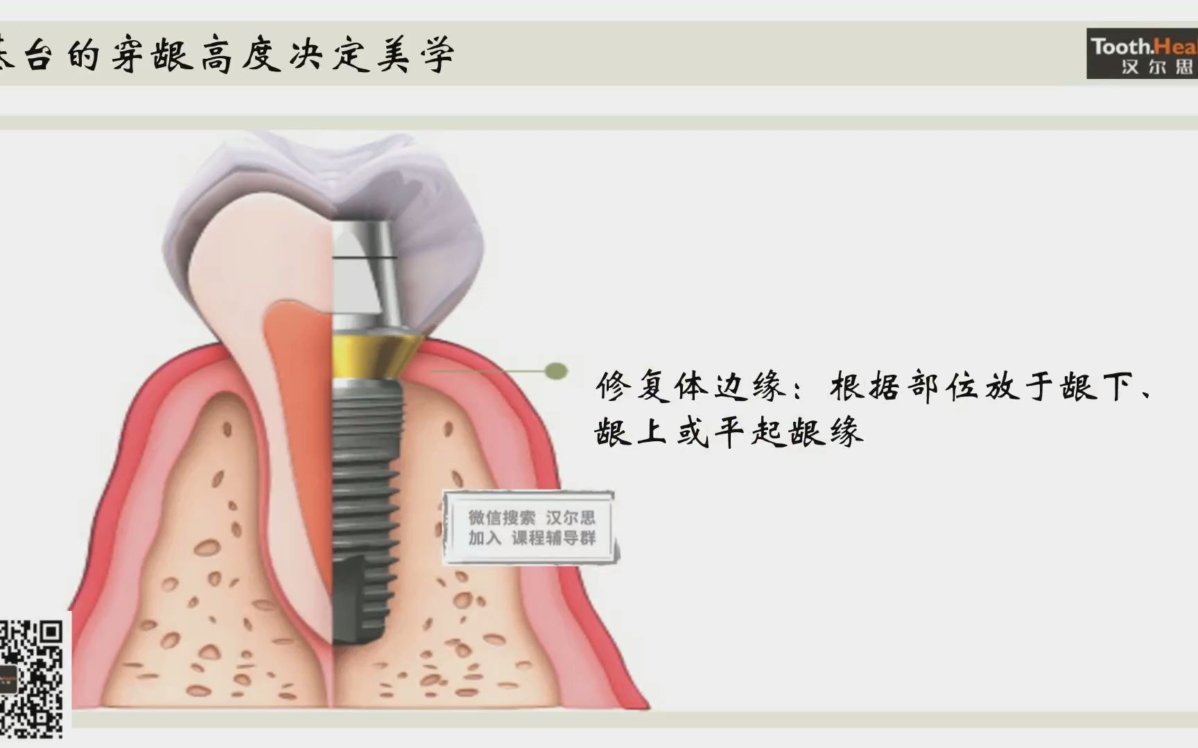 汉尔斯 种植基础训练营1哔哩哔哩bilibili