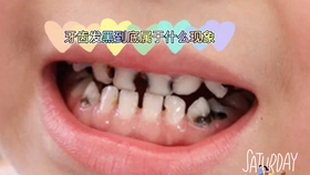 虫牙蛀牙是怎么形成的 龋齿预防 哔哩哔哩 つロ干杯 Bilibili